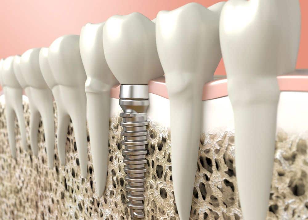 Dental Implants for Seniors ARCHPOINT Implant Dentistry