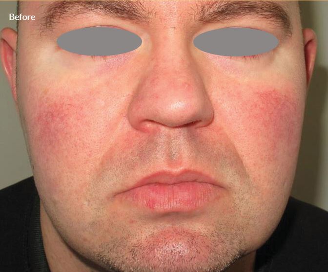 Stellar M22 Rosacea Treatment Aria Lase