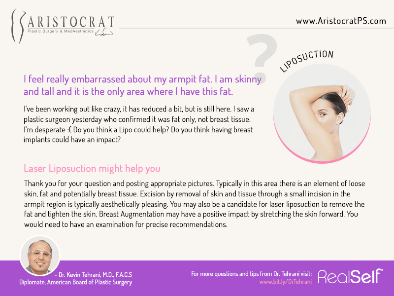 Q&A Can Liposuction remove my armpit fat tissue? Aristocrat Plastic