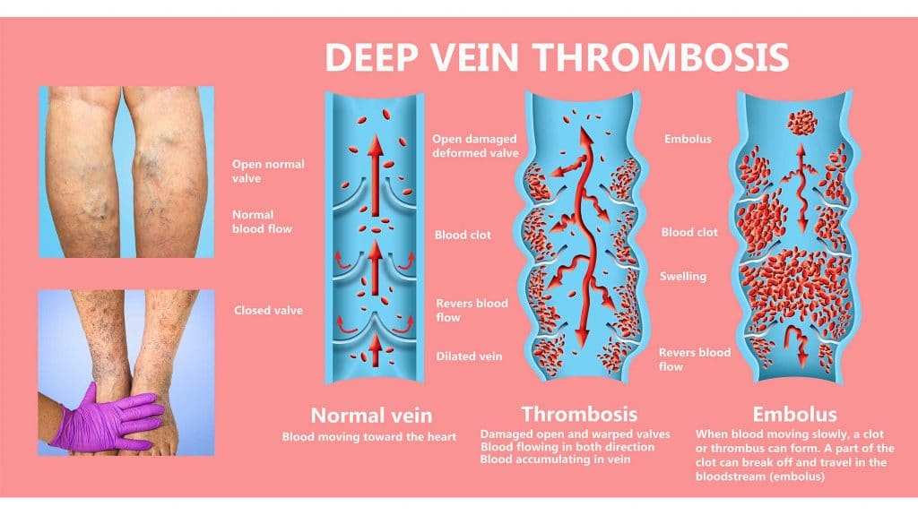 Vein Damage From IV Drug Use ARK Behavioral Health
