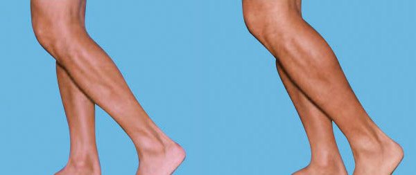 Aumento de gemelos la nueva tendencia en cirugía estética Dr