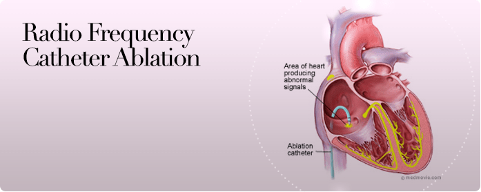 Radiofrequency Catheter Ablation Ruth Kam Heart Arrhythmia Clinic
