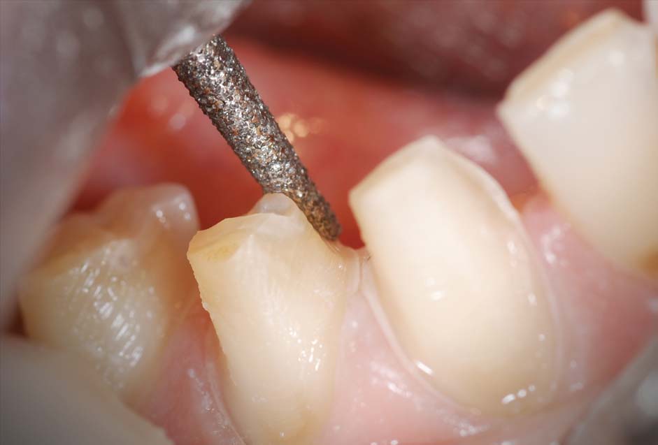 Prepping for Success inar Arrowhead Dental Laboratory