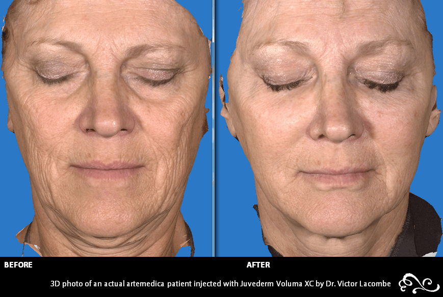 Juvéderm Voluma XC Cheek Fillers in Santa Rosa and Healdsburg