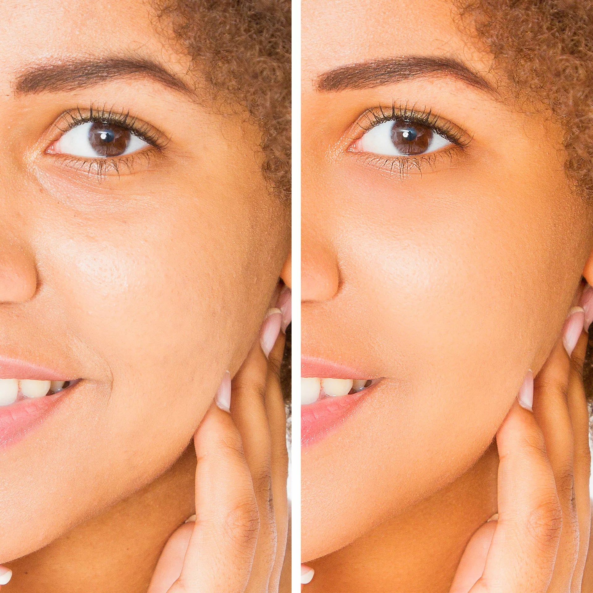 Juvéderm Skinvive Injectable Filler Santa Rosa and Healdsburg