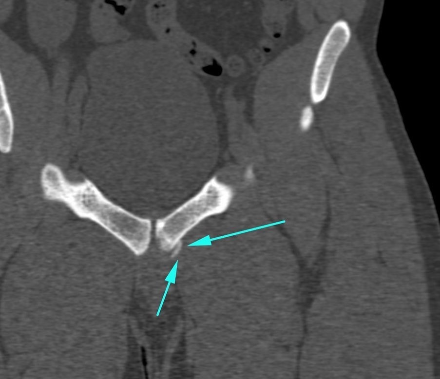 Groin Injuries in Sports Arthro One