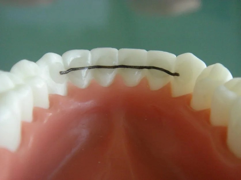 How To Clean Your Permanent Retainers?