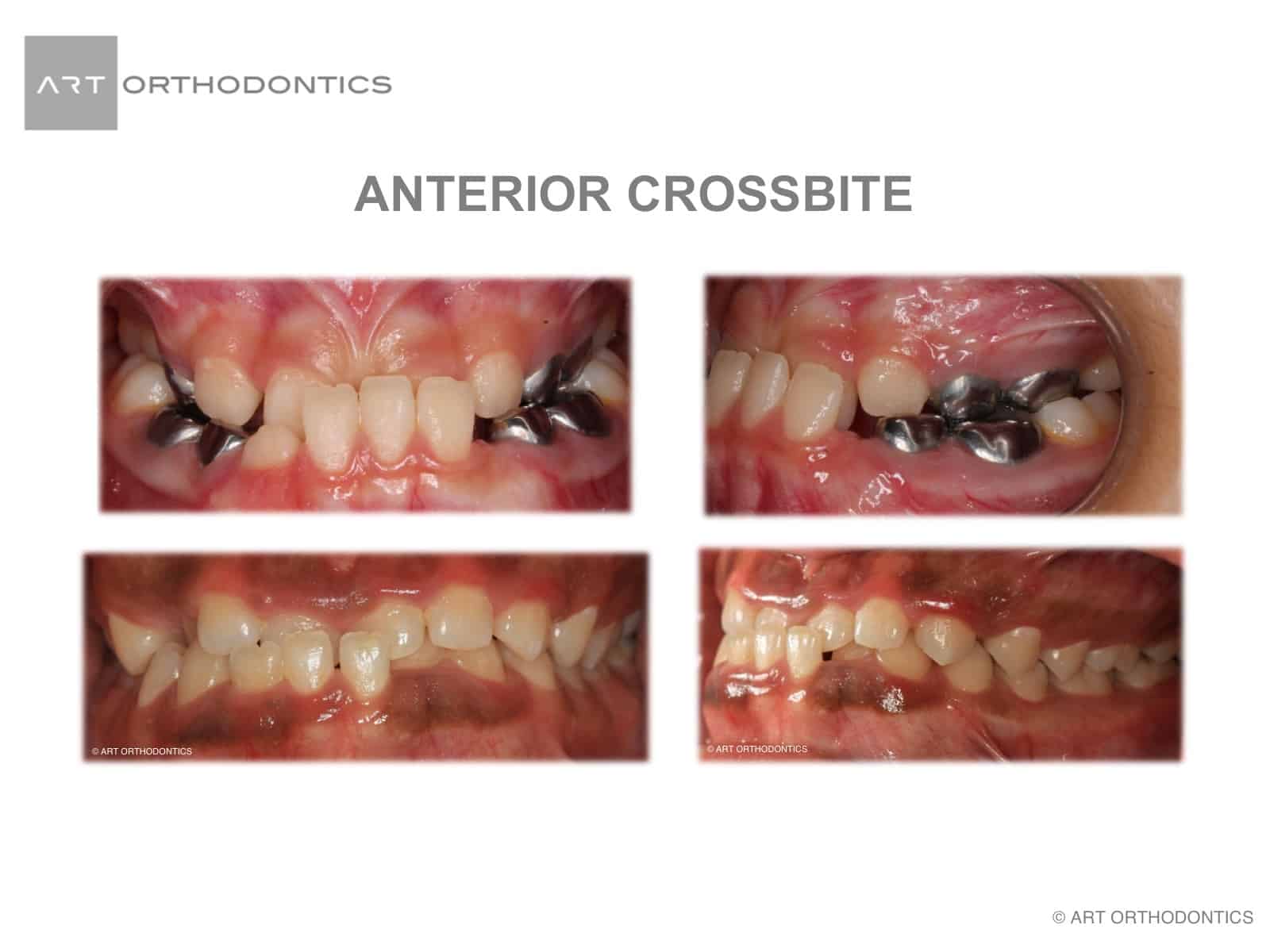 how to fix a crossbite at home desconegudes