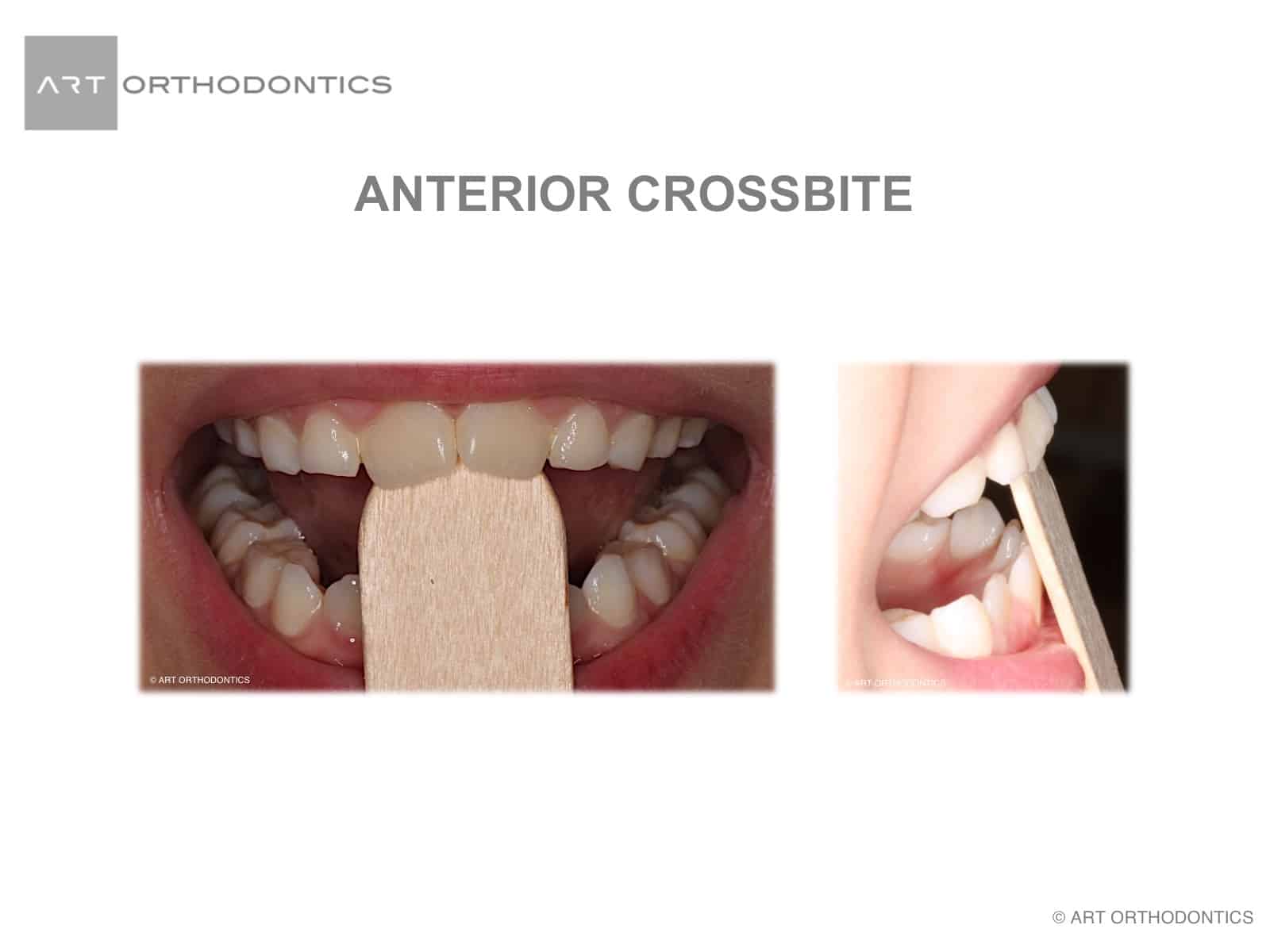 Early Orthodontics Anterior Crossbite ART Orthodontics