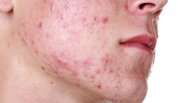 Effects of Hard Water on Skin & their Temporary & Permanent Solutions