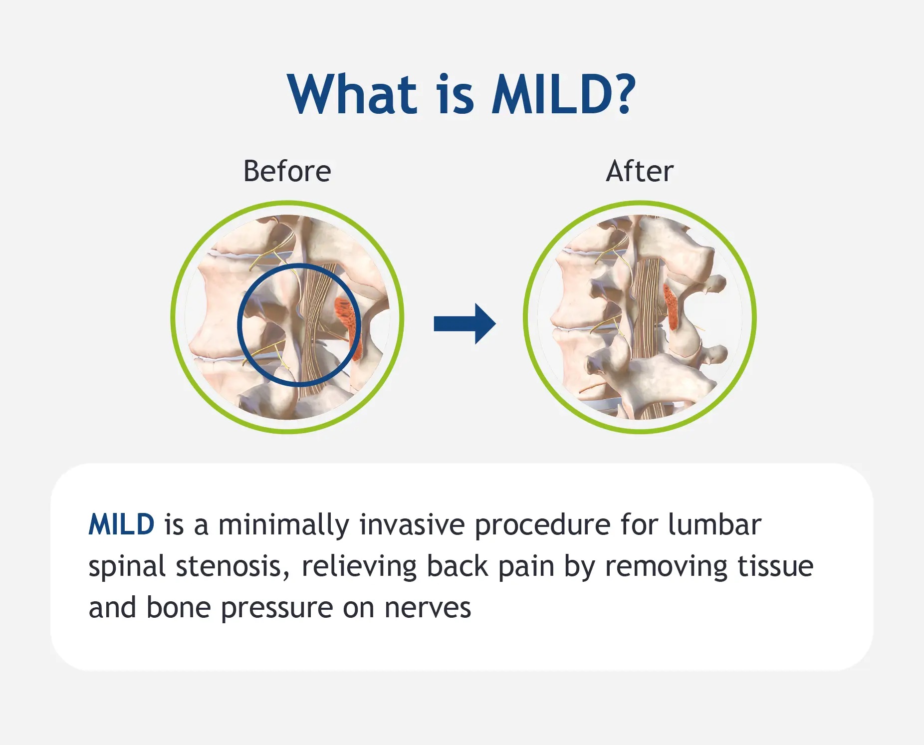 MILD Procedure | Advanced Spine and Pain