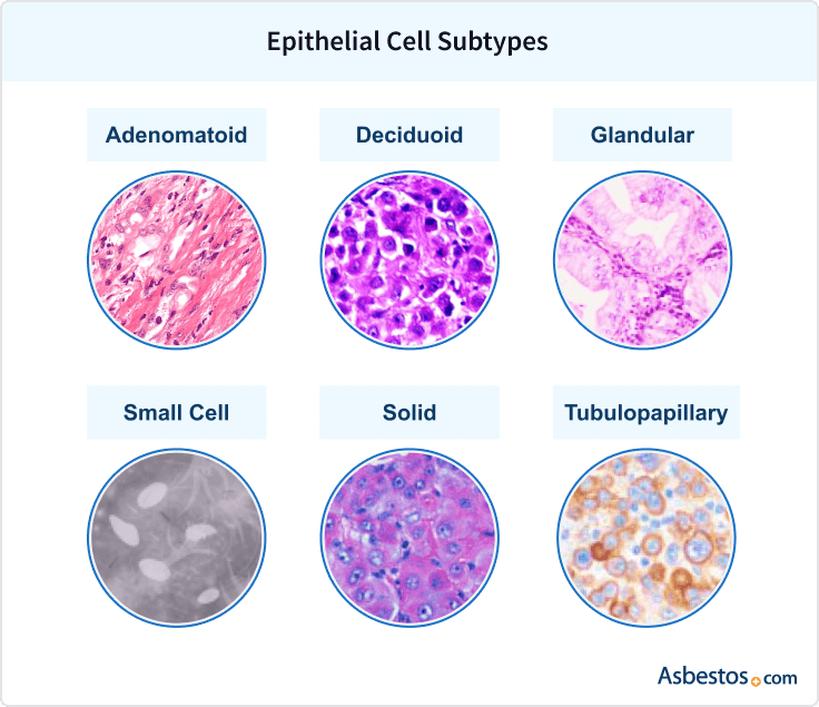 Epithelioid Mesothelioma Guide Treatment & Prognosis