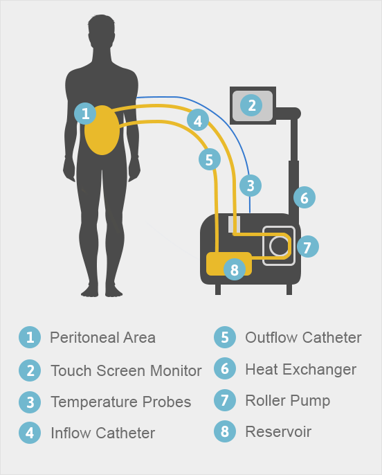 Heated Intraperitoneal Chemotherapy (HIPEC) for Mesothelioma