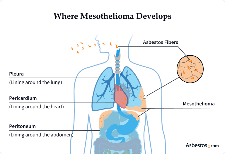 Mesothelioma Symptoms, Causes, Treatment & Prognosis
