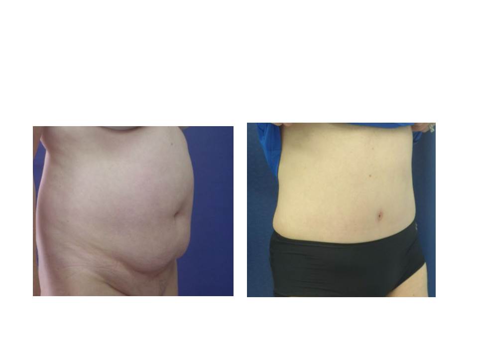 Abdominoplasty Advanced Specialty Care