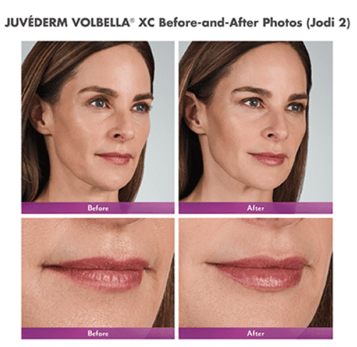 Juvederm Volbella® XC Advanced Specialty Care