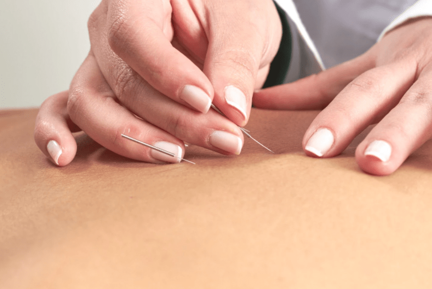 Acupuncture Treatment and Services in West Des Moines IA