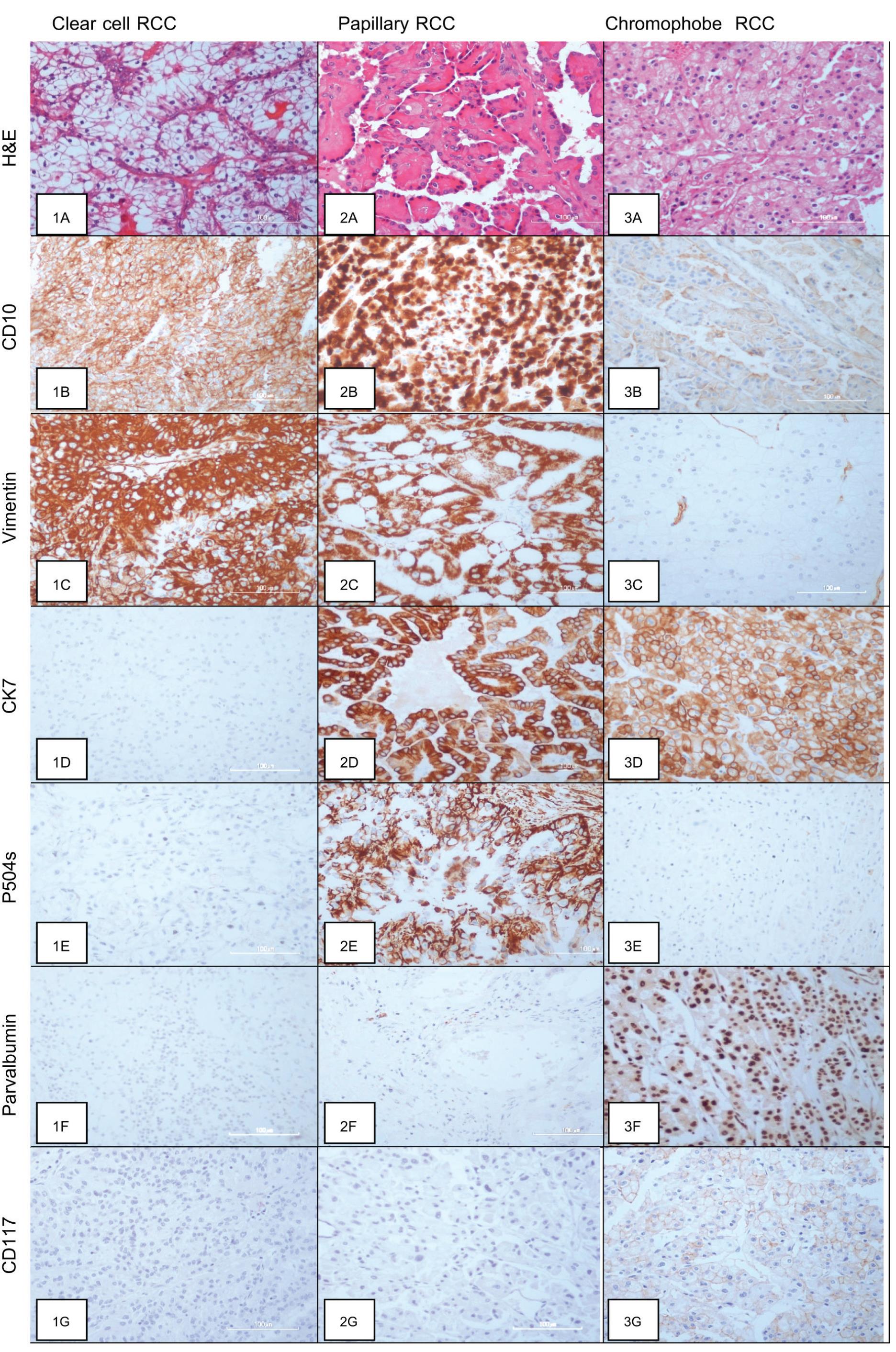 The role of Immunohistochemistry in diagnosis of renal cell carcinoma