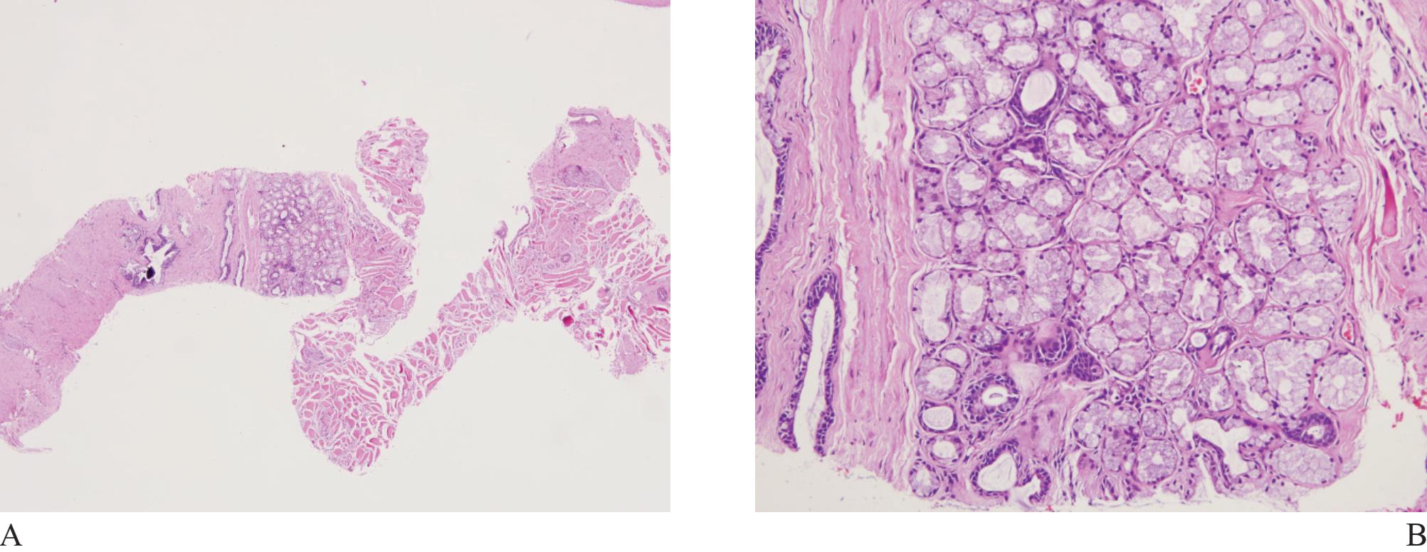 Diagnostic Pitfalls of Prostatic Adenocarcinoma in Biopsy Specimens