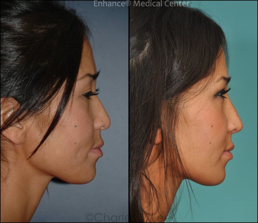 Asian nasal bridge using all natural tissue WITHOUT RIB Enhance