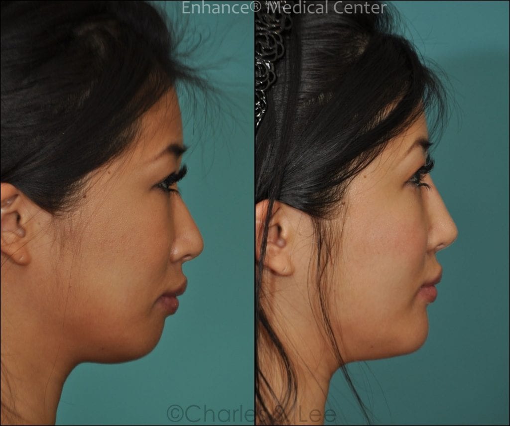 Asian nasal bridge using all natural tissue WITHOUT RIB