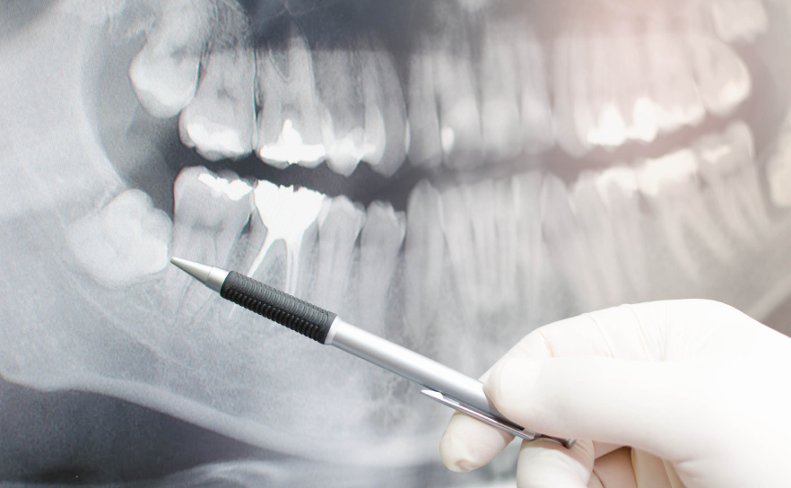 How can tooth extraction lead to cardiac arrest? AskDrManny