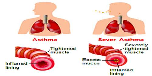 About Asthma Assignment Point