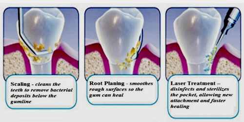 Periodontitis Assignment Point
