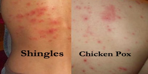 Shingles (Diagnosis, Treatment, and Preventions) Assignment Point
