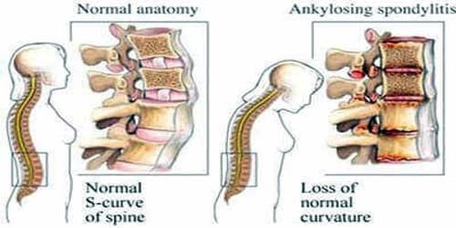Ankylosing Spondylitis (Causes, Risk factors, and Complications