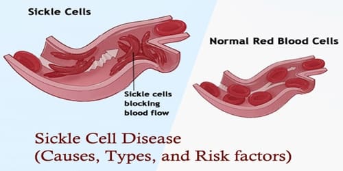 Sickle Cell Disease (Causes, Types, and Risk factors) Assignment Point