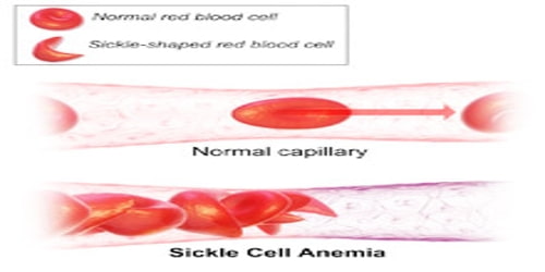 Sickle Cell Disease (Causes, Types, and Risk factors) Assignment Point
