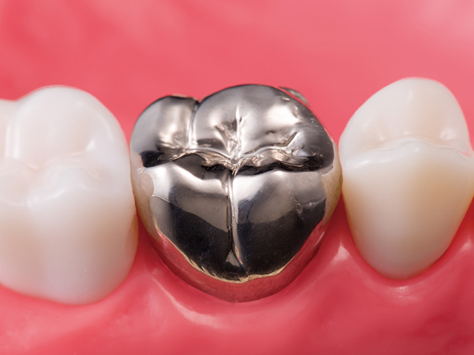 相模原市で審美歯科はセラミック治療ができるあすとら歯科クリニック相模原