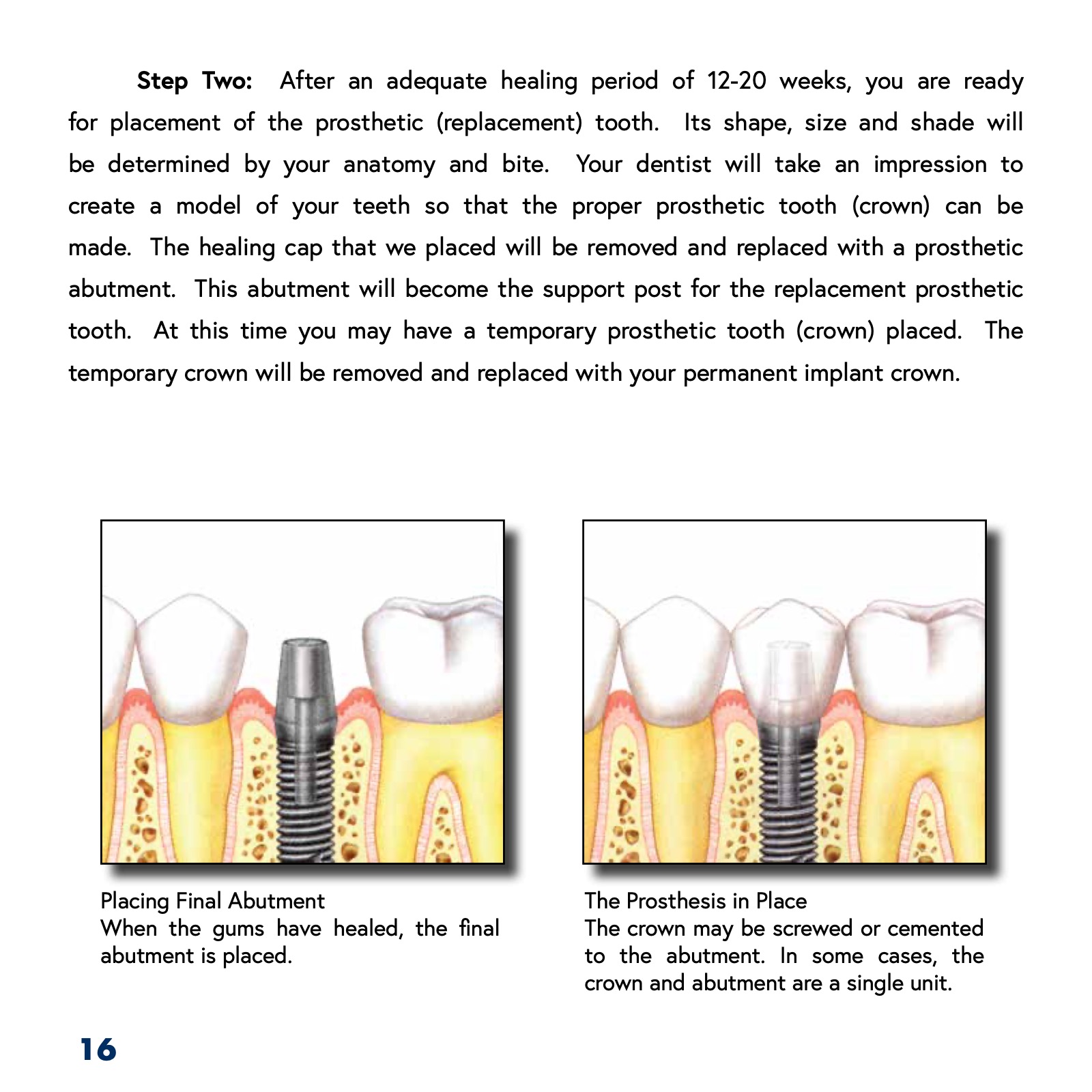 Patient's Guide to Dental Implants ATHENS DENTAL IMPLANT CENTER