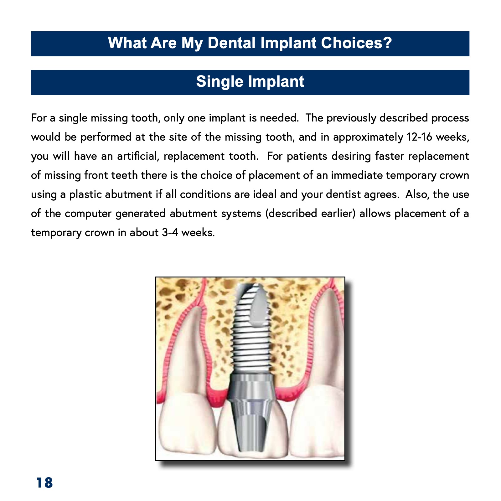 Patient's Guide to Dental Implants ATHENS DENTAL IMPLANT CENTER