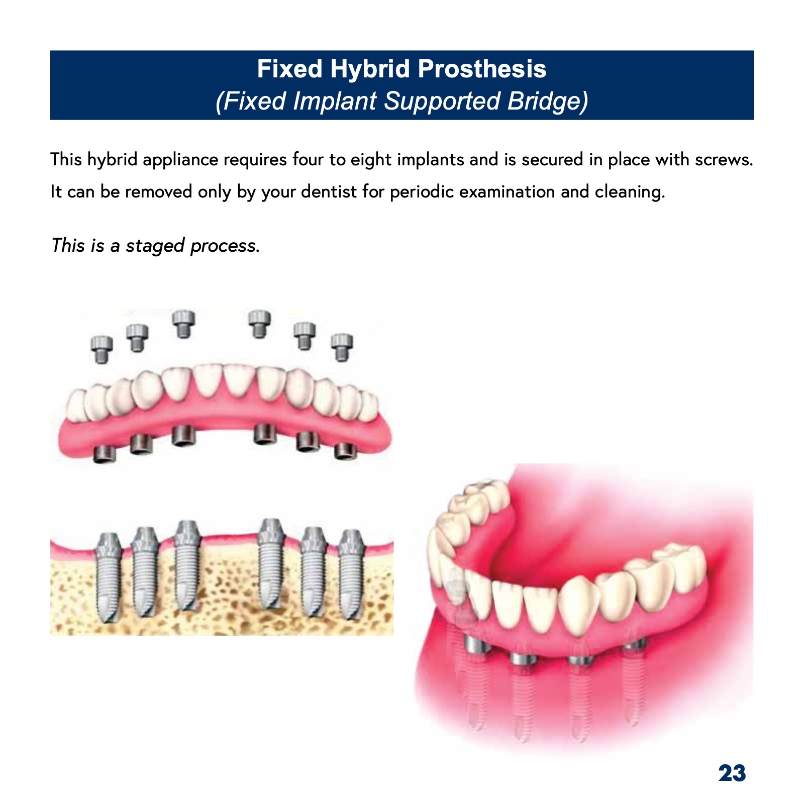 Patient's Guide to Dental Implants ATHENS DENTAL IMPLANT CENTER
