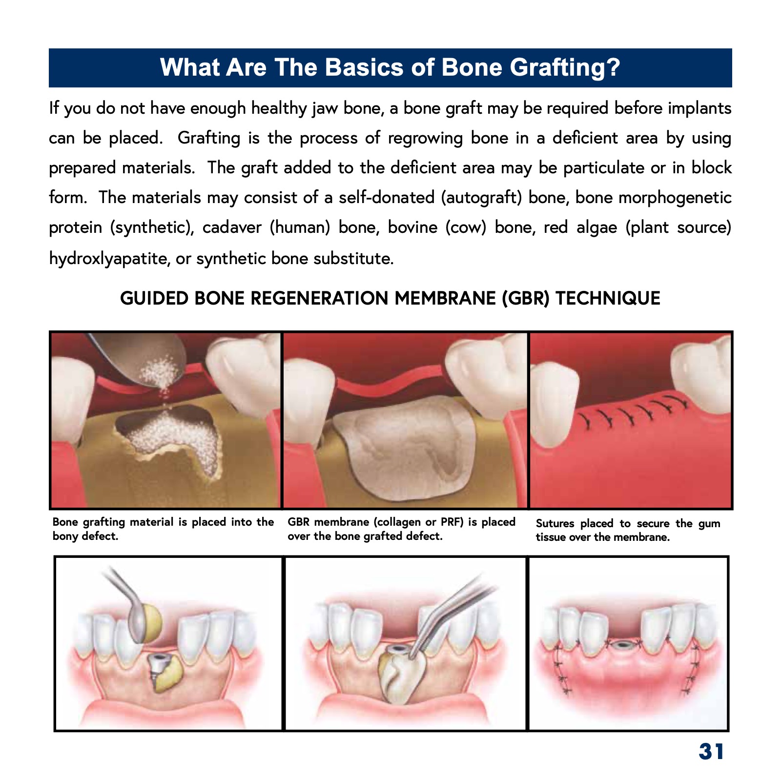 Patient's Guide to Dental Implants ATHENS DENTAL IMPLANT CENTER