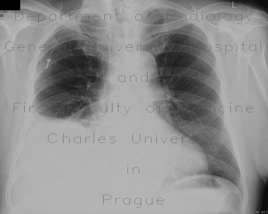 Radiology case Pleural effusion
