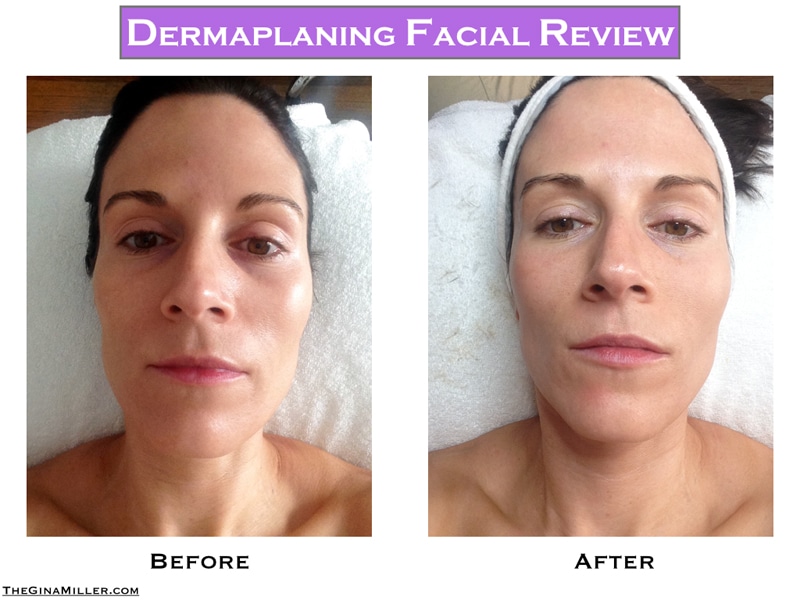 Dermaplaning Arlington Peach Fuzz Hair Removal TX