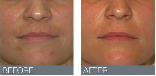 Dermaplaning Arlington Peach Fuzz Hair Removal TX