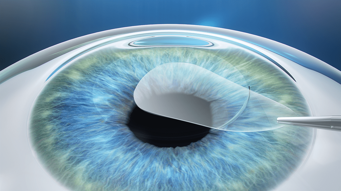 Opération des yeux au laser ReLEx Smile à Toulouse Haute