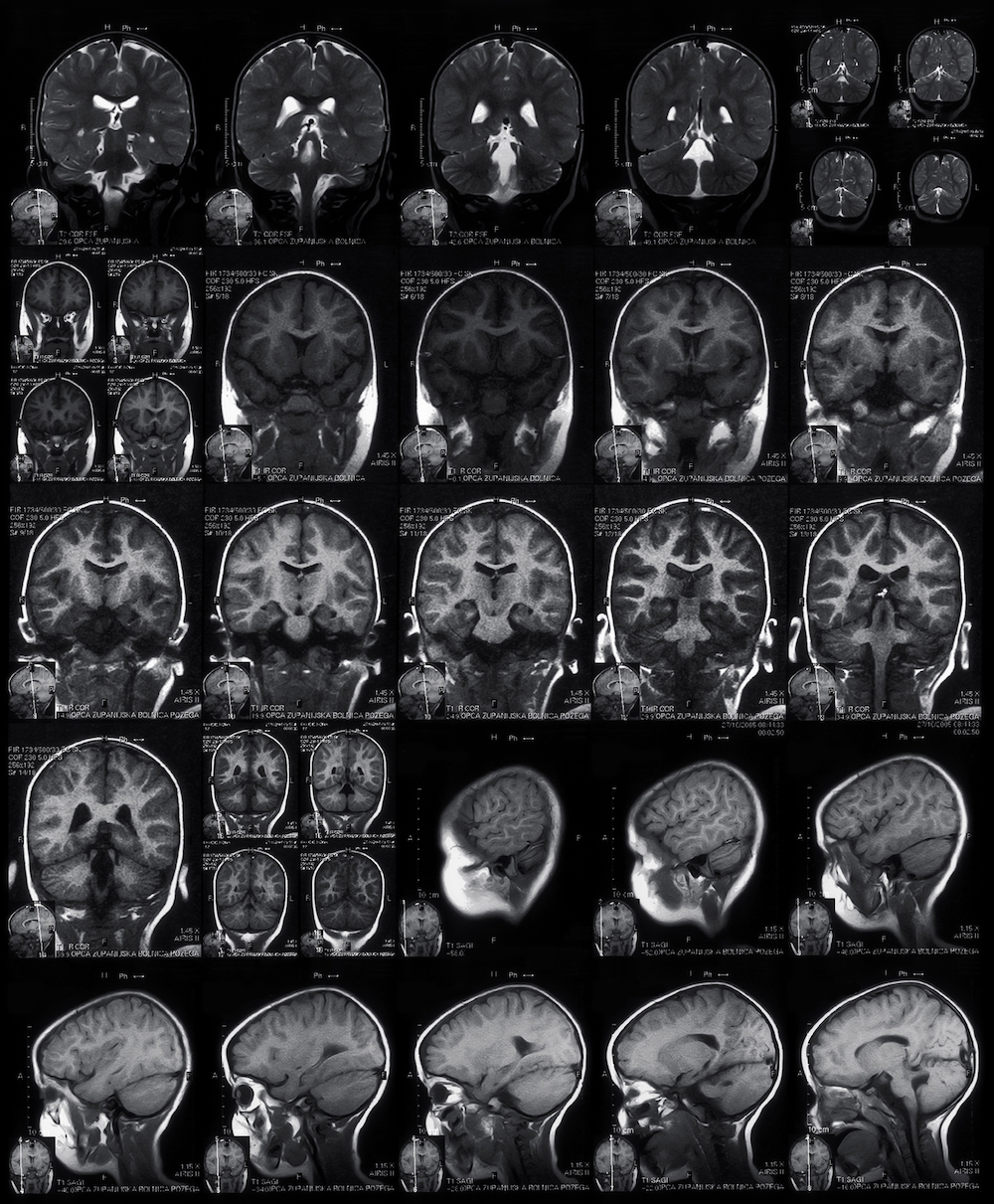 Concussion Treatment and Referral ATSU Concussion Program