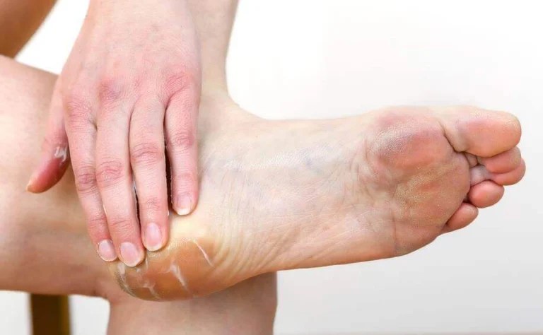 Cor au pied un épaississement désagréable et très