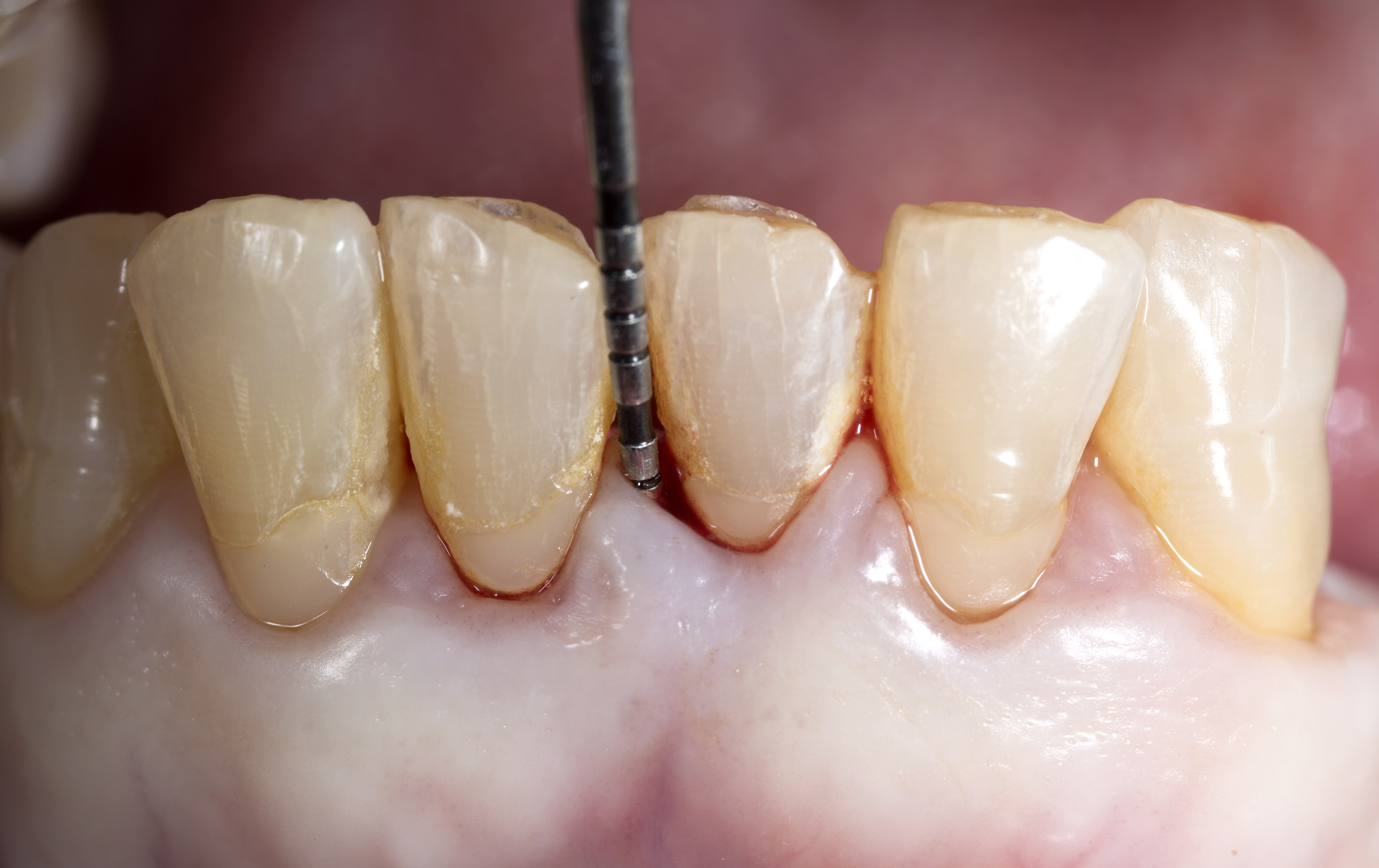 What is Periodontitis?
