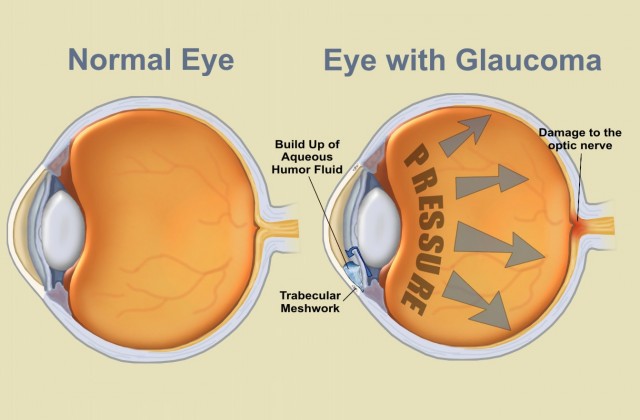 Augenlasern in der Türkei, Lasik in Istanbul