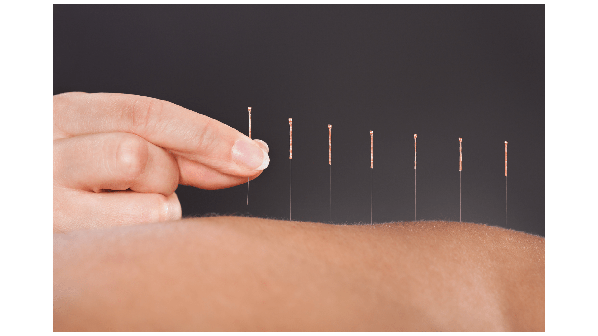 Acupuncture & Dry Needling at North Lakes, Morayfield Auscare Physio