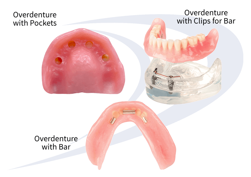 Overdentures AvaDent Digital Dental Solutions