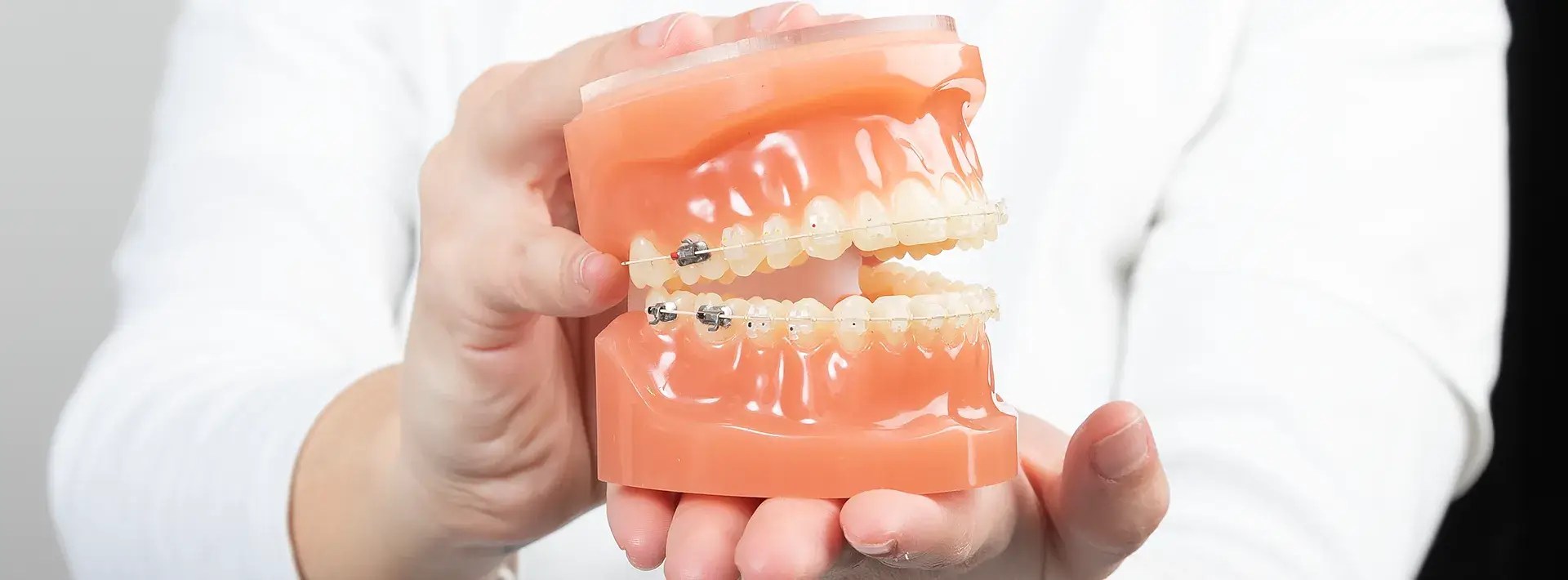 Brackets de Zafiro ventajas, duración y precio • Clínica Dental AVODENT