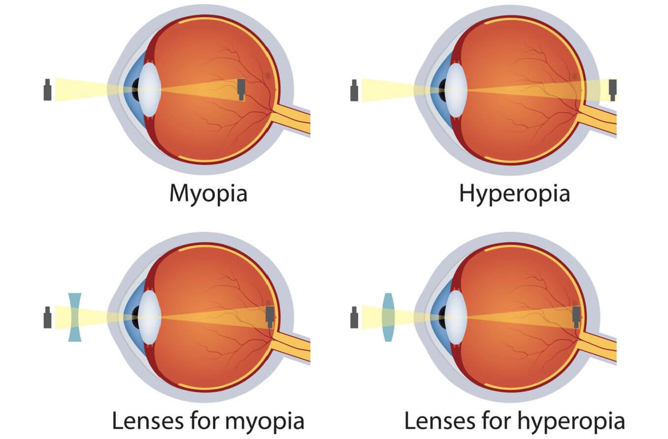 Ayurvedic treatment of myopia in india Prakash Nethralaya