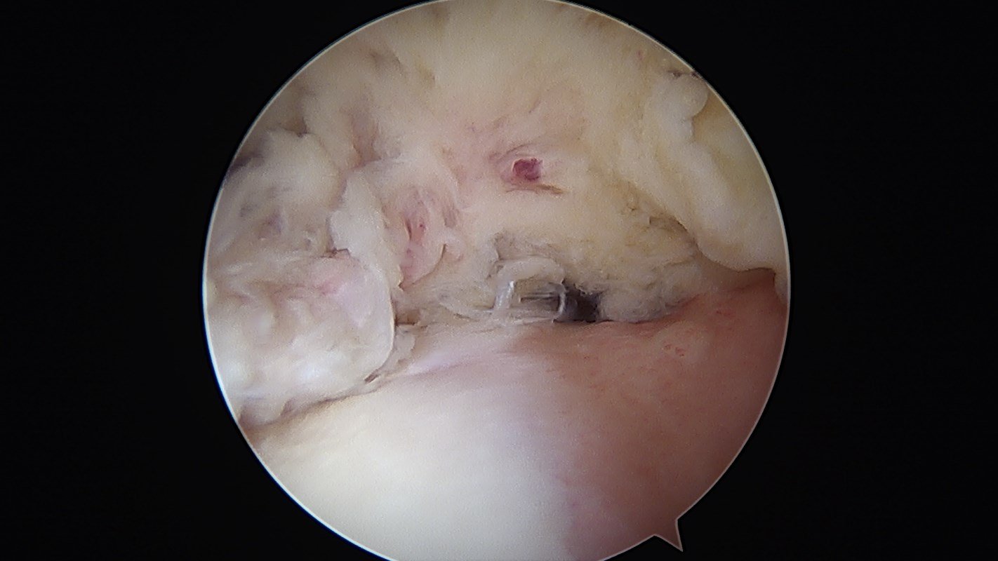 Rotator cuff tear (1) Arizona Institute for Sports, Knees and Shoulders